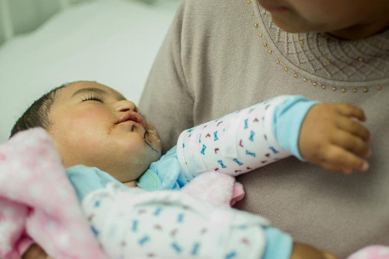 Our medical volunteers surgically repaired Gael's cleft palate. This surgery further corrected the condition that prevented him from being able to ingest food and speak clearly.