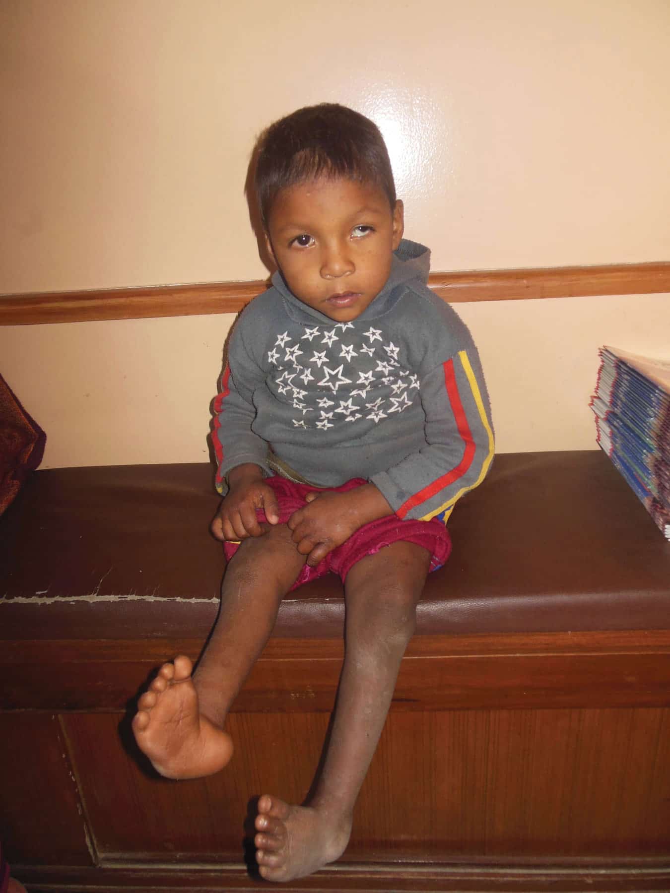 Sumit before he received help from Samaritan’s Purse’s “Patient Navigation Program”.